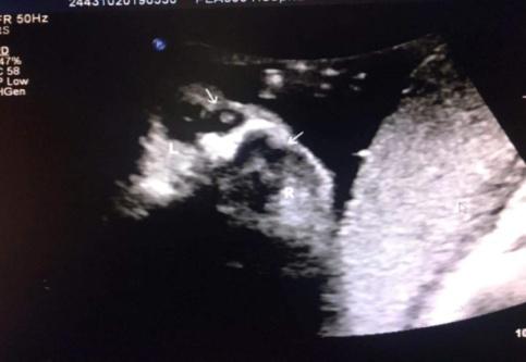 胎儿左右眼内侧无回声鼻泪管囊肿,胎儿鼻泪管囊肿超声诊断