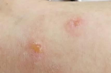 瘢痕体质剖腹产后会痛会痒吗,疤痕体质剖腹产后怎么处理