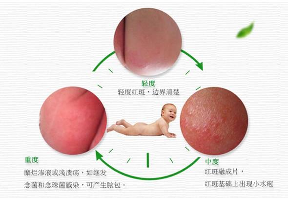 宝宝红屁股的原因和护理方法,宝宝红屁股破皮快速好方法