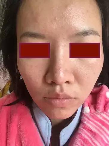 「许师解疑」难治性*疮痤**案析酸寒法