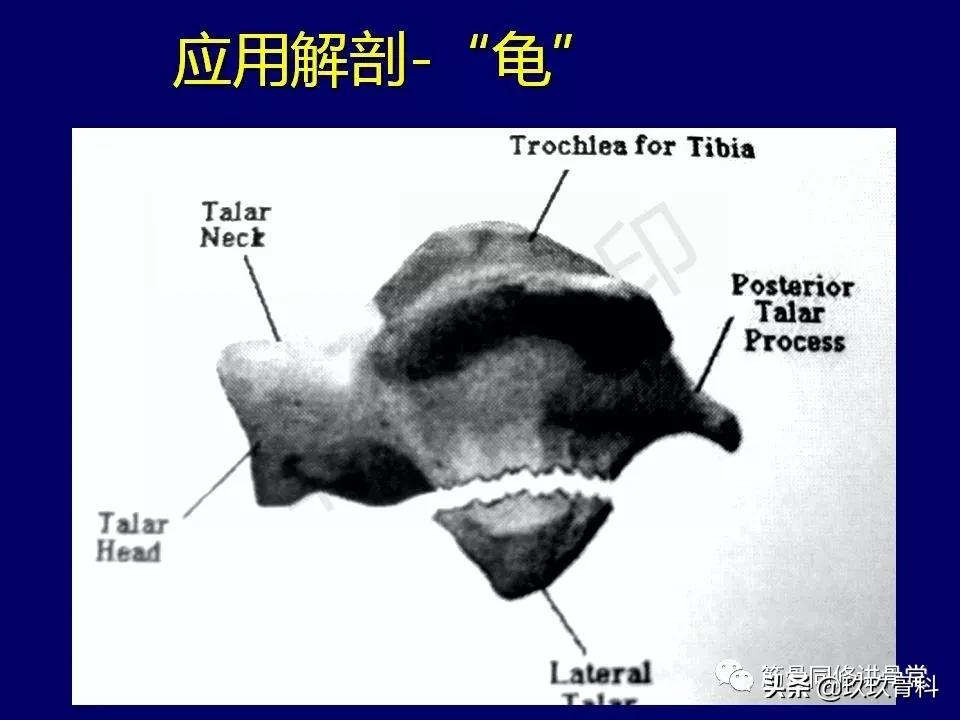 距骨骨折的治疗原则,距骨骨折如何调理