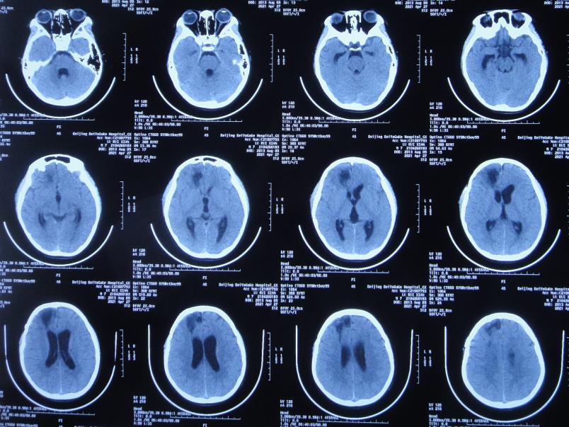 儿童脑出血昏迷三天后恢复正常了,脑出血后脑积水多久会出现症状