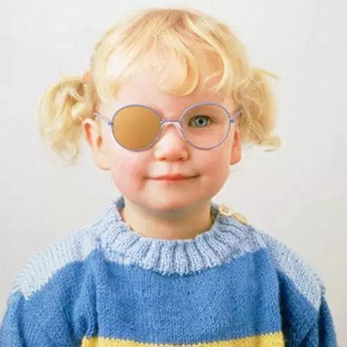 5岁儿童弱视需要怎么训练矫正吗,高度近视引起弱视怎么矫正