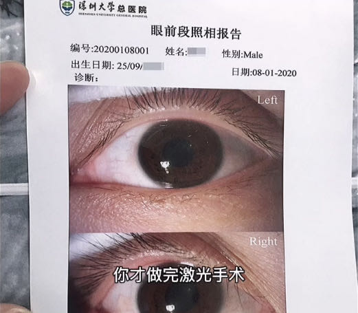 激光近视手术两眼视力不一致,激光近视手术视力回退