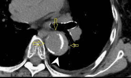 肠系膜上动脉夹层,心脏动脉夹层破裂