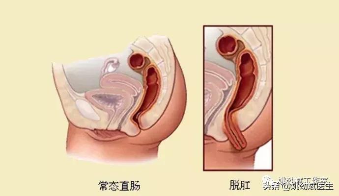 肿物自肛门脱出就是痔疮?太天真了