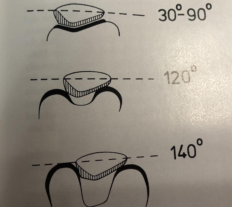 膝盖附近疼是髌骨软化症引起的吗,髌骨膝前疼痛综合症