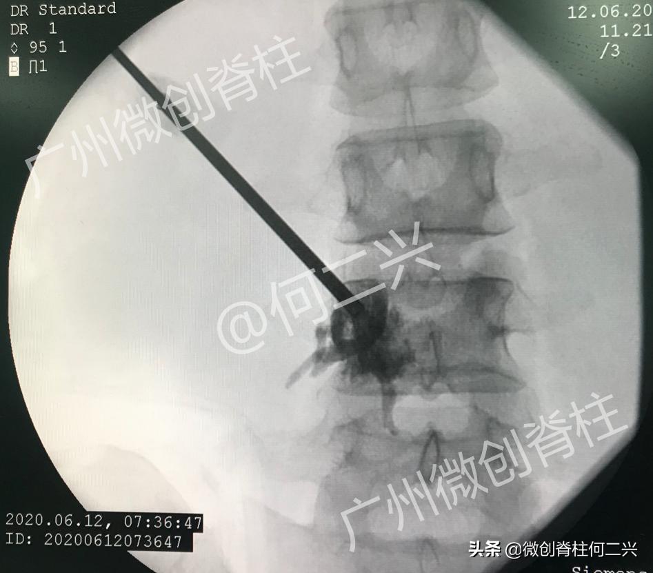 精准微创治疗案例：针尖上的技术——微波消融治疗脊柱转移性肿瘤