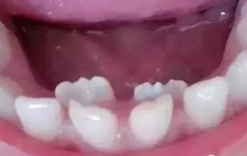 孩子换牙后牙齿越来越难看,小孩换牙为什么牙齿凹凸不平图片