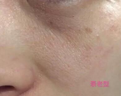 激光缩小毛孔一个疗程多少钱,脸部毛孔缩小做哪个皮肤项目