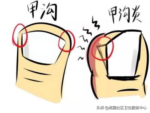 甲沟炎防治,甲沟炎怎么预防息肉