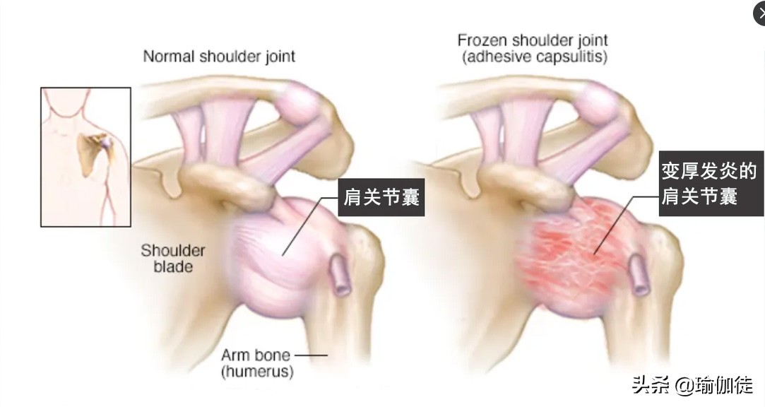 五十肩真的自己就能好了吗,五十肩的好处和坏处