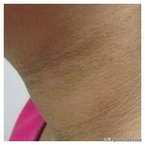 黑棘皮病怎样快速去除,如何有效快速去除黑棘皮病