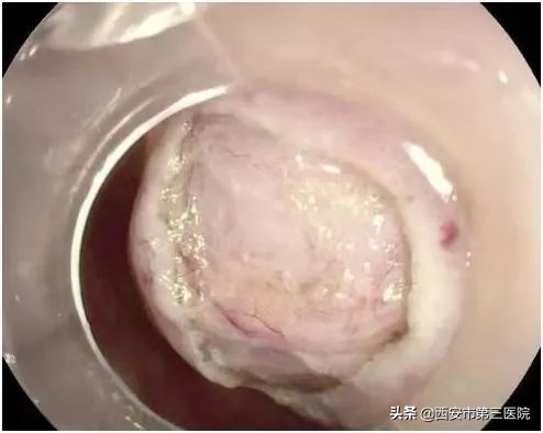 微创时代|内镜下微创直肠肿瘤切除，为您保“肛”