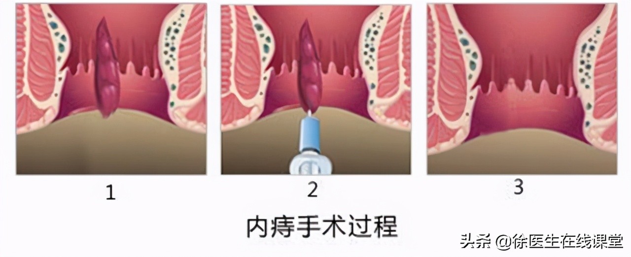 肛门边有个肉球不痛不痒怎么治疗,肛门外有个肉球不痛不痒怎么治疗