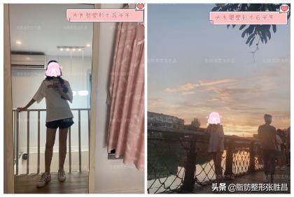 大腿吸脂后可以穿一般的紧身裤吗,大腿吸脂一个多月紧身裤还要穿吗