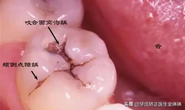 小蛀牙补牙,小蛀牙可以修复吗