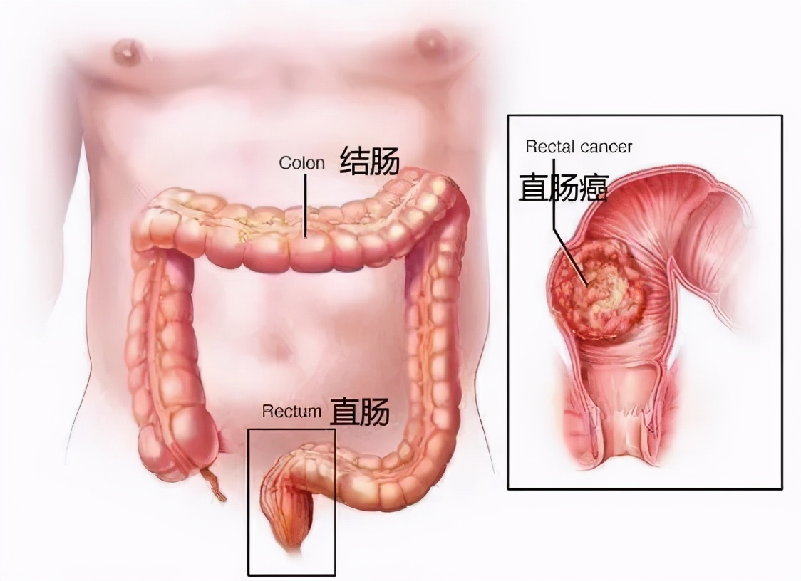 低位直肠癌保肛手术需造瘘吗,低位直肠癌手术有吻合口吗