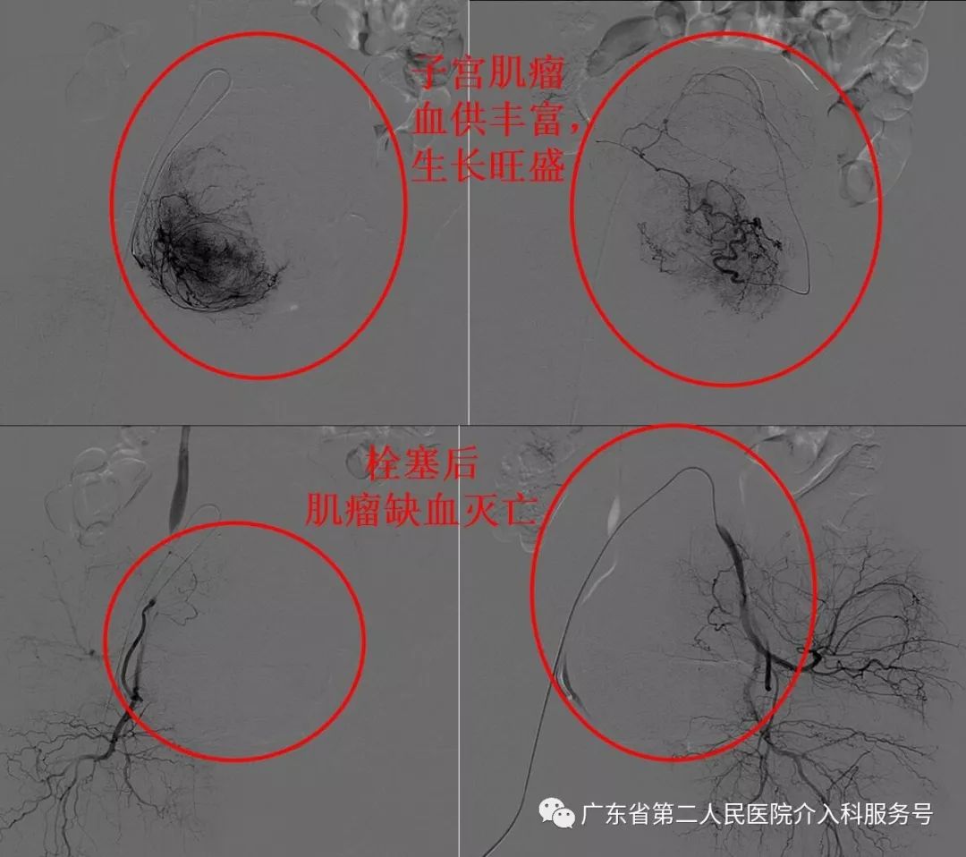多发子宫肌瘤浆膜下,浆膜下多发子宫肌瘤怎么办