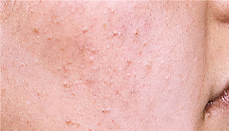 痘痘的周期一般是几天,痘痘的心酸史