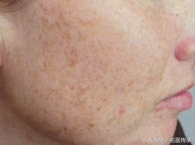 肝气郁结脸上长肝斑怎么治,肝气郁结和肝气郁滞怎么调理