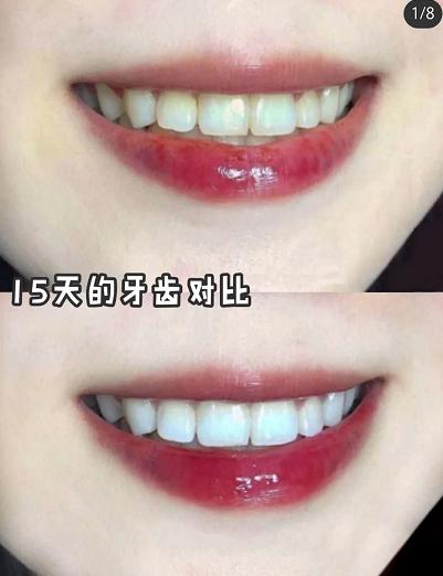 李佳琦牙齿怎么变白的,李佳琦怎么变白的