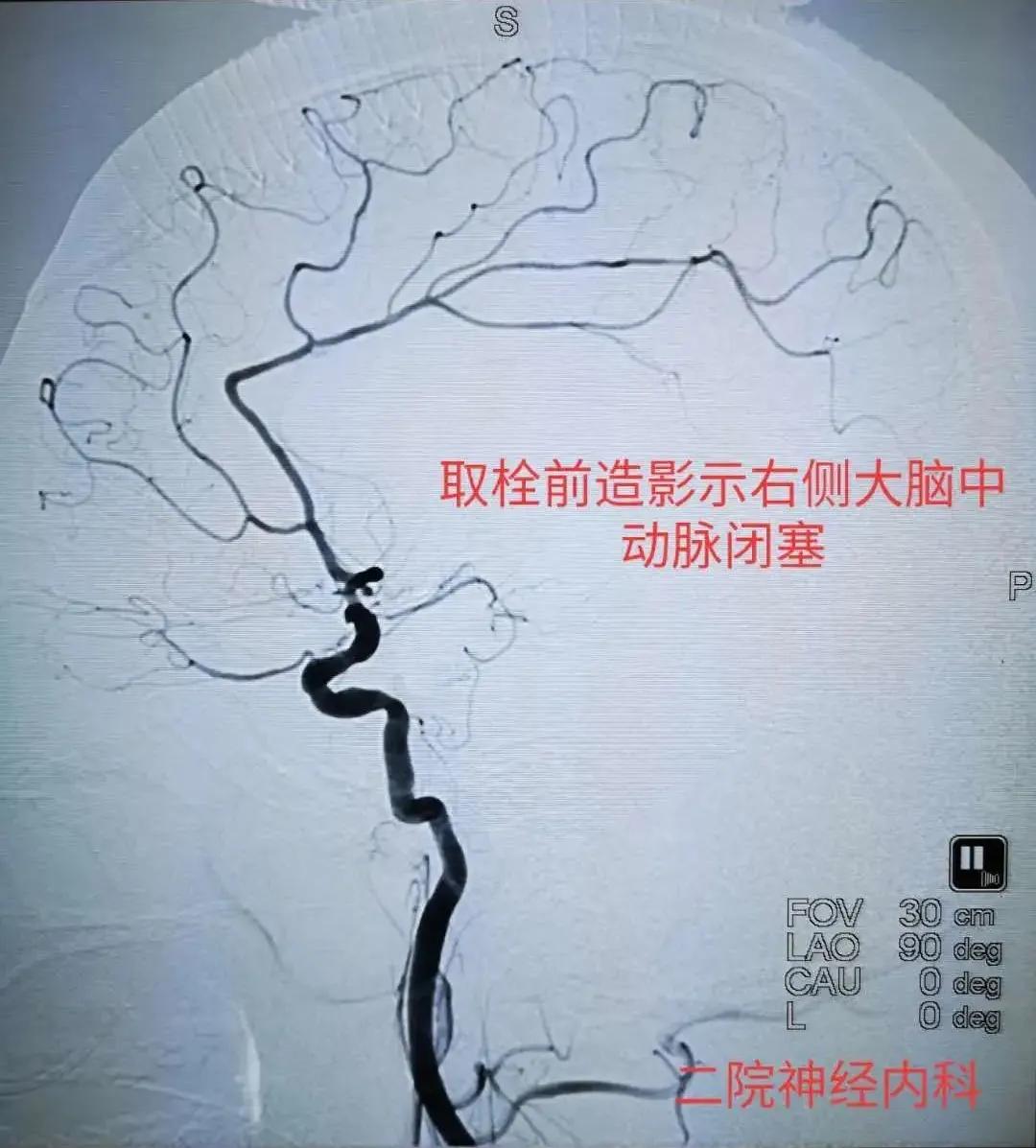 经皮颅内动脉取栓术全过程,为患者打开生命希望之门