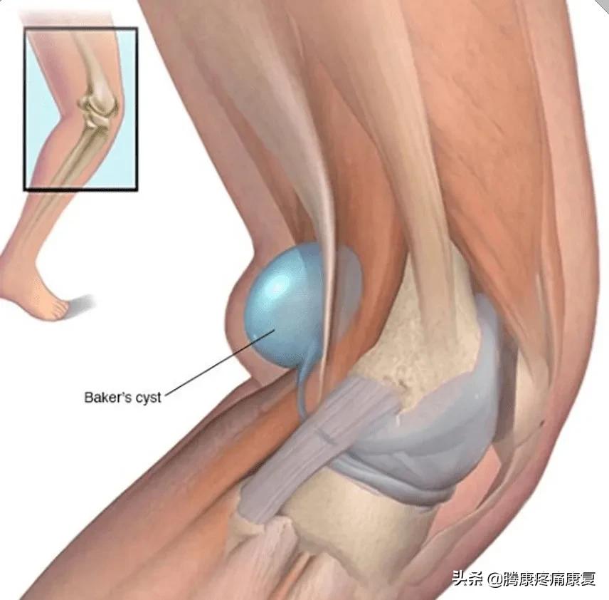小腿膝关节疼痛是什么原因,小腿窝疼痛是什么原因造成的