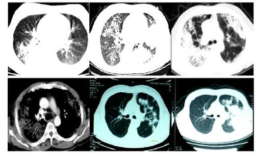 强化ct和ect哪个确诊肿瘤准确,ct与ect哪个危害大