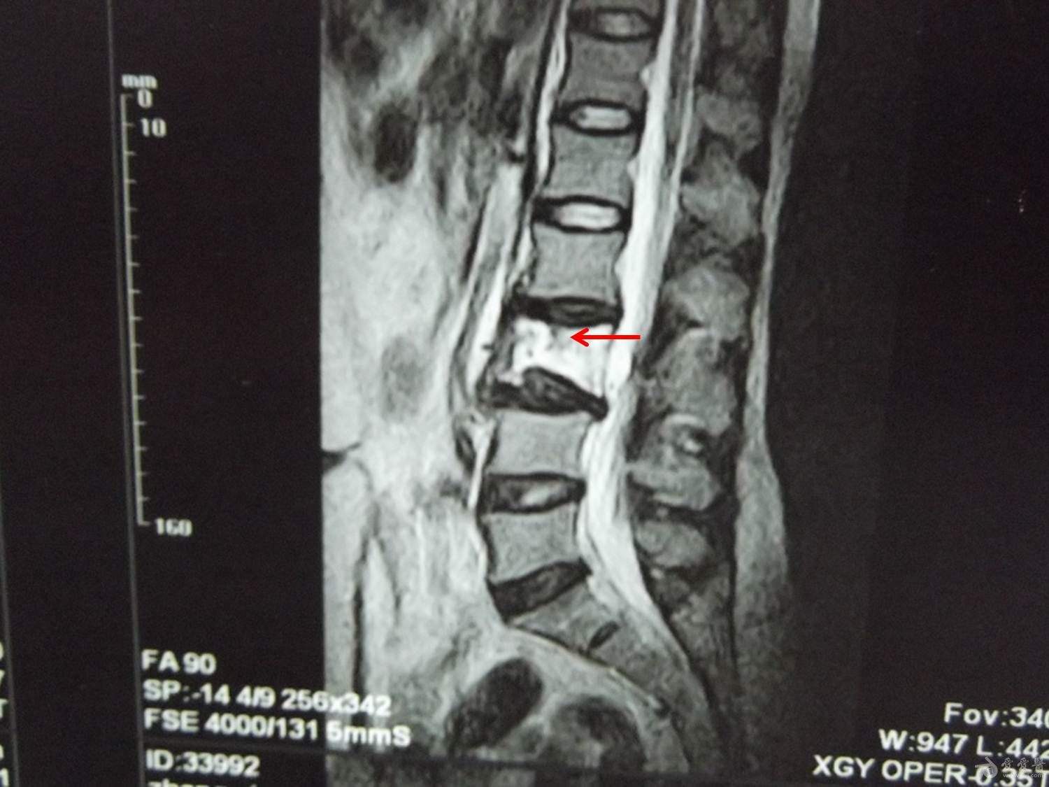 良性病可以做放疗吗?