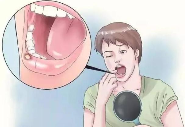 宝宝口腔溃疡怎么治疗最好,宝宝有口腔溃疡怎么治好得快