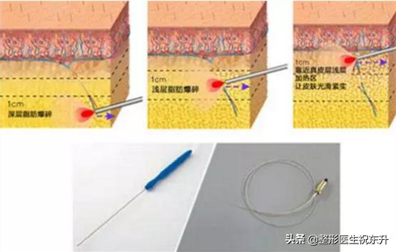 射频溶脂减肥手术具有三大并发症,做激光美容前需要注意什么