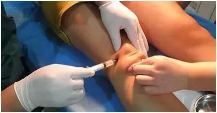 关节腔注射治疗OA：玻璃酸钠or糖皮质激素？