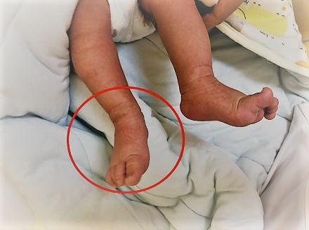 足内翻导致的小腿外翻怎么办,足内翻是怎么样