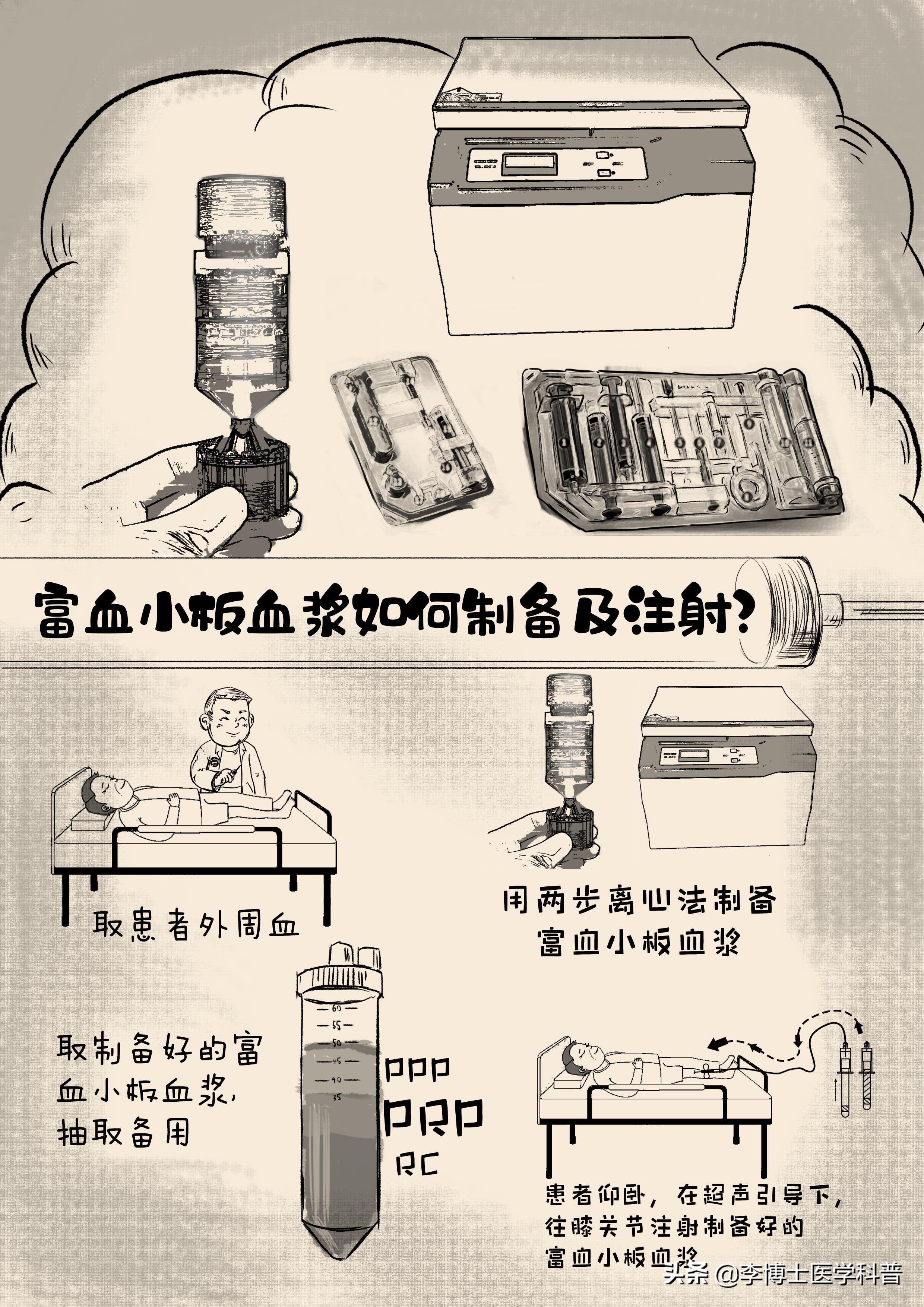 注射富血小板血浆会有疼痛呢,prp富血小板血浆疗法科普