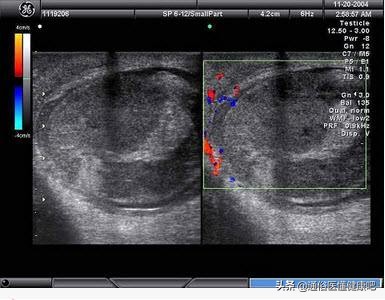 “蛋蛋”变硬？15~35岁男性最需注意的癌变预兆