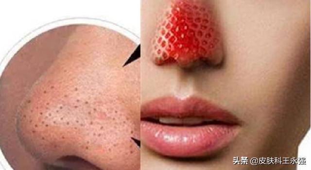 鼻子上挤出来的白条状东西是什么,鼻子可以挤出很多白色丝状物