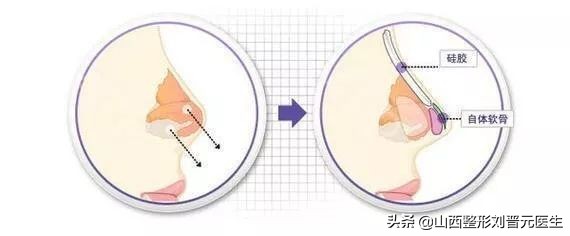 捏鼻子能让鼻梁变高,婴儿捏鼻梁变高真的吗