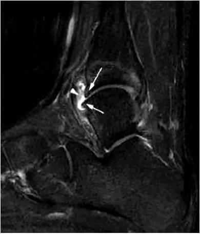 踝关节撞击症问诊,踝关节内侧撞击综合症位置图