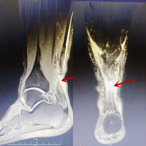 跟腱断裂轻度功能障碍鉴定标准,跟腱出现问题前有什么表现