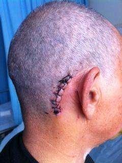 微血管减压术怎样,做微血管减压术权威医生排名