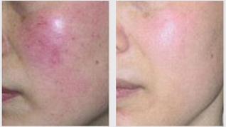 m22光子嫩肤的功效和作用,m22光子嫩肤的功效和作用价格