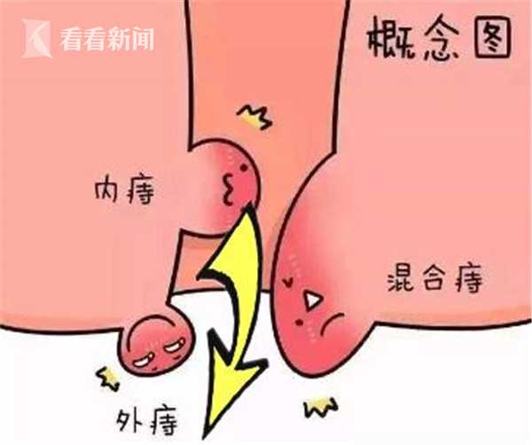 十人九痔和十男九痔,十人九痔内痔