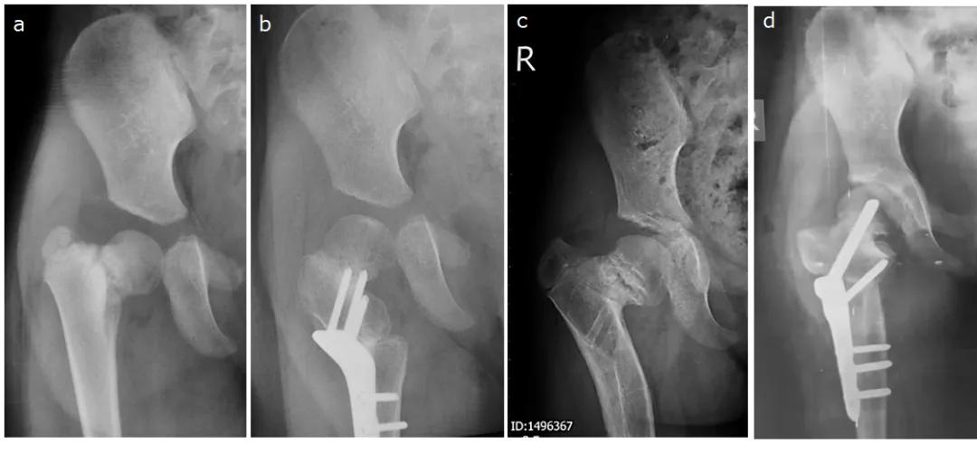 小儿先天性髋内翻名词解释,小孩走路颠足内翻