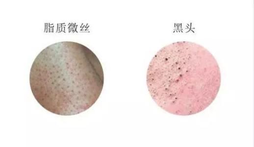 如何解决四种不同类型的黑头,3招教你搞定真假黑头