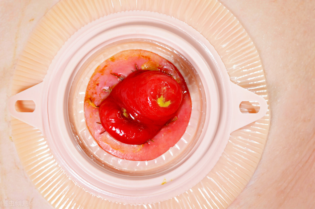 直肠癌吻合口瘘完全恢复需要多久,直肠癌吻合口瘘一般要冲洗多少天