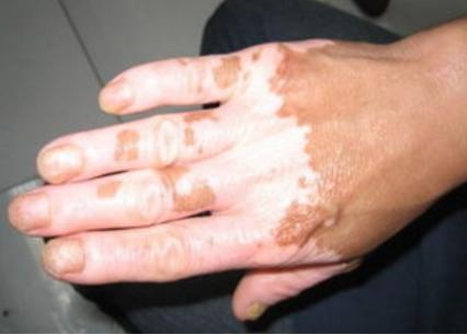 老年人身上长白斑怎么治才能根除,年轻人得了老年性白斑怎么办