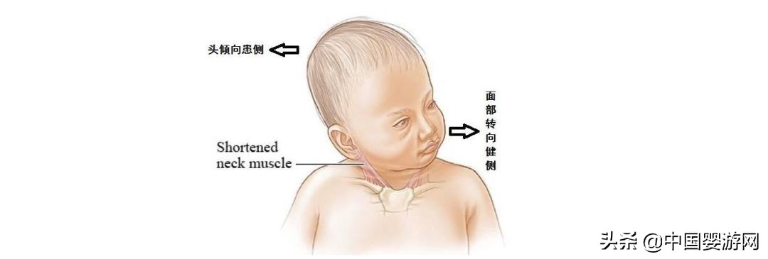 宝宝歪头怎样牵拉纠正,婴儿歪头平躺可以纠正吗