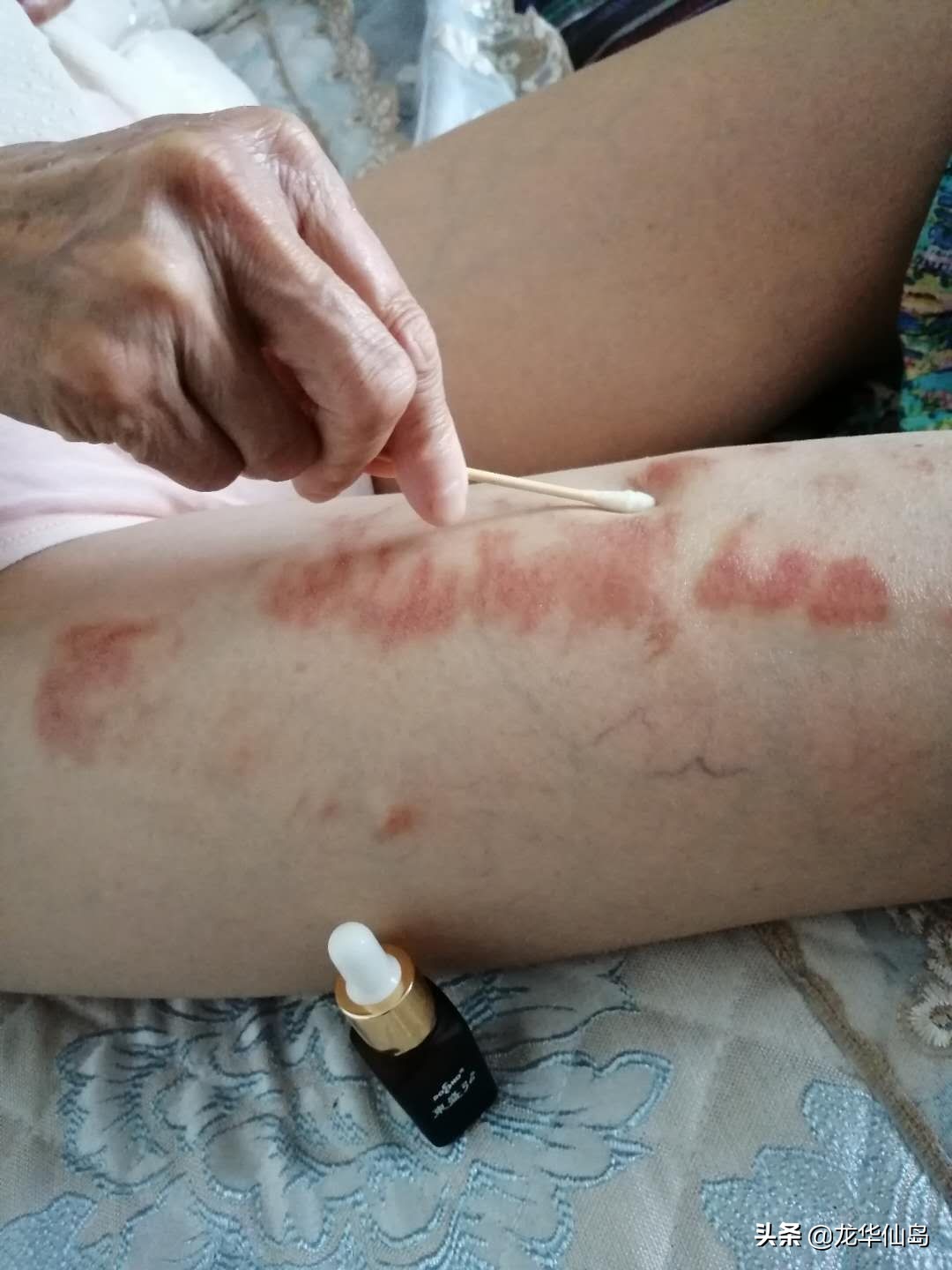 蟒蛇油使用案例与方法