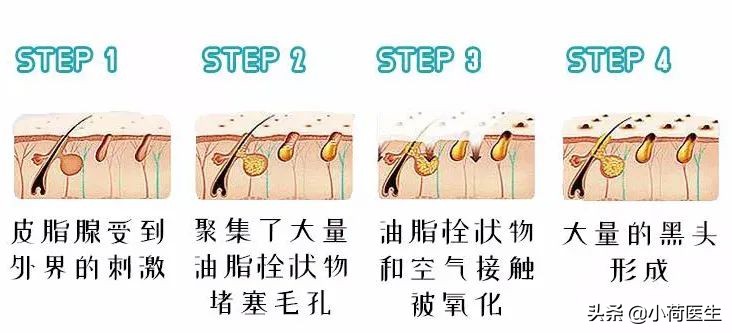 黑头怎么祛除最快最有效的方法,激光祛黑头可以让黑头变少吗